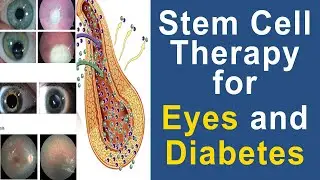 stem cell therapy for Eye problem - Diabetes and nerve damage - Watch it full Video