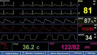 Simulated Adult Patient ICU Monitor with Low Pulse Ox