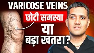 पैरों की Varicose Veins बिना सर्जरी आधुनिक इलाज | Modern Non-Surgical Treatment of Varicose Veins