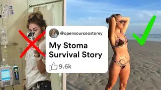 My Ostomy Story | Colitis, Crohn&rsquo;s, Surgery & Getting My Life Back