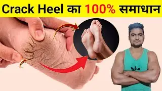 Crack Heel Home Remedy l Cracked Heels Treatment l Crack Heel Cream l Crack Heel Cure in Hindi l