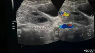 A case of blood clots &  RPOCS ( shows  increased vascularity on CD/ PD ) on ultrasound