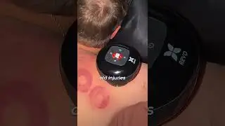 best cupping device