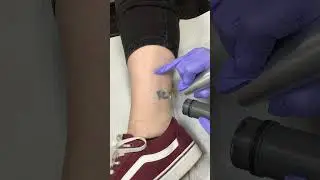Tiny tattoo, big change! #lasertattooremoval #removery #asmr