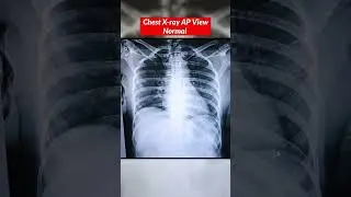 Chest X-ray Normal vs Fracture ⚡️Ribs Fracture #chestxray #xray #fracture #bones