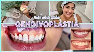 FIZ GENGIVOPLASTIA | Cirurgia + Recuperação + Retoque + Resultado em fotos 💎