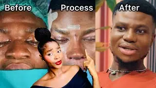 The truth about Zicsaloma’s rhinoplasty surgery | Is he gay? | #Nosejobe #zicaloma #contentcreator