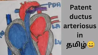 patent ductus arteriosus in Tamil #cardiovascular system #valve disease in tamil