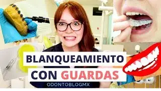 ¡¡Me hice un Blanqueamiento Dental con Guardas!! // Explicación paso a paso