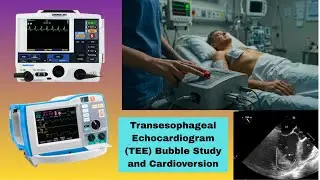 Transesophageal Echo & Cardioversion for Atrial Fibrillation