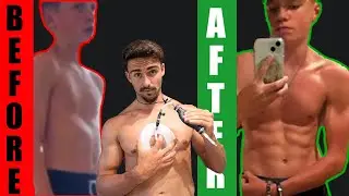 Teenagers Guide to Treating Pectus Excavatum