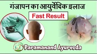 Alopecia Treatment By Leech Therapy -  गंजापन अब होगा ठीक बिना Transplant के | No Side-Effects