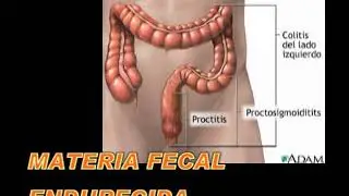 Colitis y Gastritis