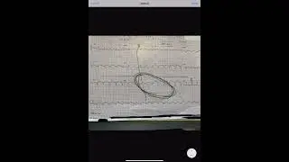 ECG - LOW VOLTAGE - AXIS DEVIATION- ESTIMATING EJECTION FRACTION