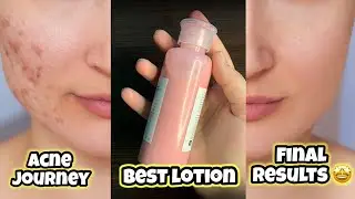 Best Lotion For Acne,Redness,itching \Sunburn in Just 160 | Calamine Shocking Results in just 1 USE