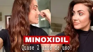 MINOXIDIL: Meu cabelo vai CAIR se eu parar de usar? RESPONDI tudo após quase 2 anos de uso!