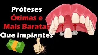 Prótese Fixa e Adesiva - Ótimas Opções Para Substituir Dentes Perdidos Além do Implante Dentario