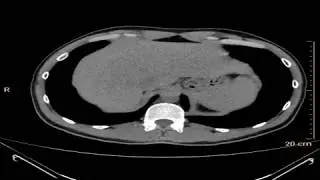 horseshoe kidneys