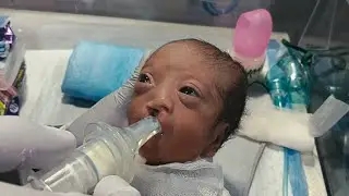 Cleft Lip Baby Feeding in NICU | MMC, Sepsis & Leg Paralysis Care by Male Nurse