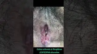 Lichen sclerosis et atrophicus vulva| LSEA| dermatologist in Chandigarh|white patches|Dr Ashima Goel