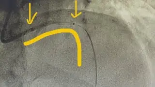 90 degrees LM-LAD, NSTEMI, Long Lesion, Use of Guidezilla Extension Catheter