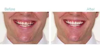 Smile Makeover by 209 NYC Dental specialists