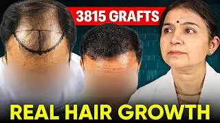 If Your Hairline Looks Like This 😰 Watch Now | Saraswat Hospital Hair Loss