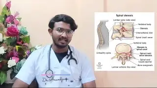 &ldquo;Can&rsquo;t walk without pain? This Might Be Why!&rdquo; #Lumbarspinalstenosis #backpain #sciatica  #awareness