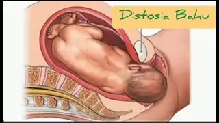 Penanganan Distosia Bahu dengan Manuver McRoberts, Rubin, Woods, Bahu Belakang