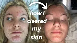 Tips on getting clear skin 2020
