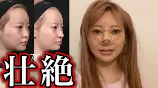 【鼻整形】まりなの再々手術が過酷すぎました。
