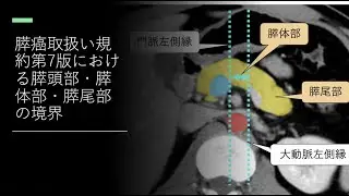 膵癌取扱い規約第7版における膵頭部・膵体部・膵尾部の境界