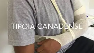 Tipoia Canadense (simula&ccedil;&atilde;o)