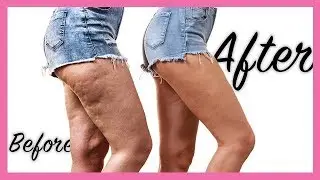 DIY Cellulite & Stretch Marks Oil - Smooth Legs for Summer