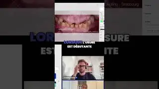 Rallongement Incisives: Technique Compl&egrave;te et Conseils! #shorts