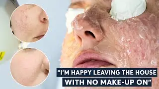 5 Foods That Triggered My Rosacea | London
