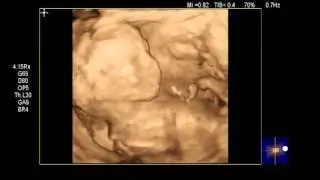 3D echo zwangerschap 18 weken