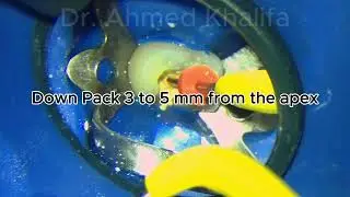 Continuous Wave Compaction - Clinical step by step