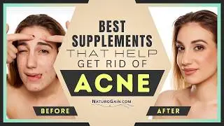 What Supplements Help Get Rid of Acne? Effective Herbal Solutions