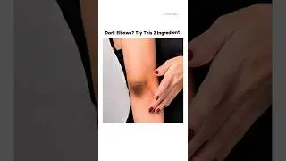 Dark Elbows? Try This 2 Ingredient #shorts #darkelbows #darkknee #beauty #fyp #glowup #skincare #bts