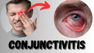 conjunctivitis || how to treat pink eyes|| conjunctivitis treatment