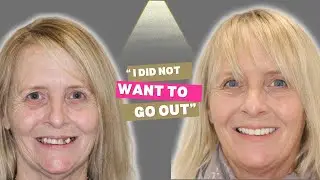 How Dental Implants Changed My Life - Top Rated Dentist Leicester