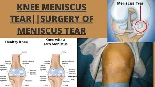 Knee Meniscus Tear||Surgery Of Meniscus Tear||Zeenad Learning Hub