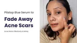 Pitstop Blue Serum to Fade Away Acne Scars || Acne Marks Effectively & Safely