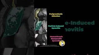 (Fig 5-D.19) Post-TKA Synovitis: Infection, Particle-Induced, and Nonspecific
