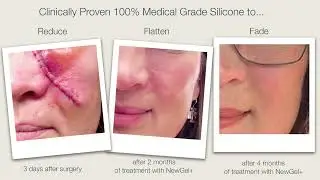 NewGel+ scar care