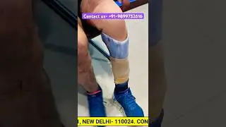 #artificiallimb #belowkneeamputee #prosthetics #legprosthesis