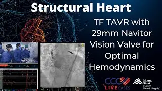 TF TAVR with 29mm Navitor Vision Valve for Optimal Hemodynamics