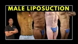 &ldquo;Struggling with Stubborn Belly Fat? Discover Male Lipo 360 Transformation | Dr. Pakeman NYC&rdquo;