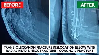 🔴 Trans-Olecranon Fracture Dislocation | Elbow Dislocation With Radial Head & Neck Fracture 